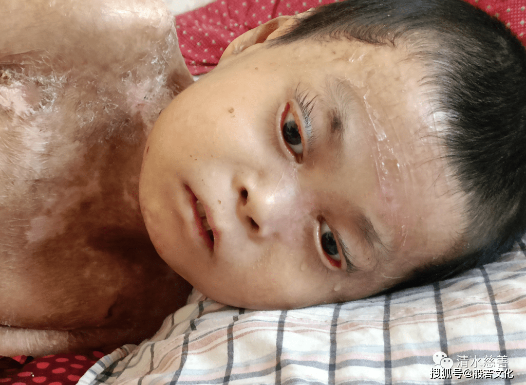 清水慈善再次探望"玻璃男孩":他的康复梦实现了吗?