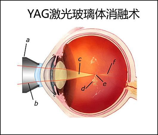 yag激光玻璃体消融术图片
