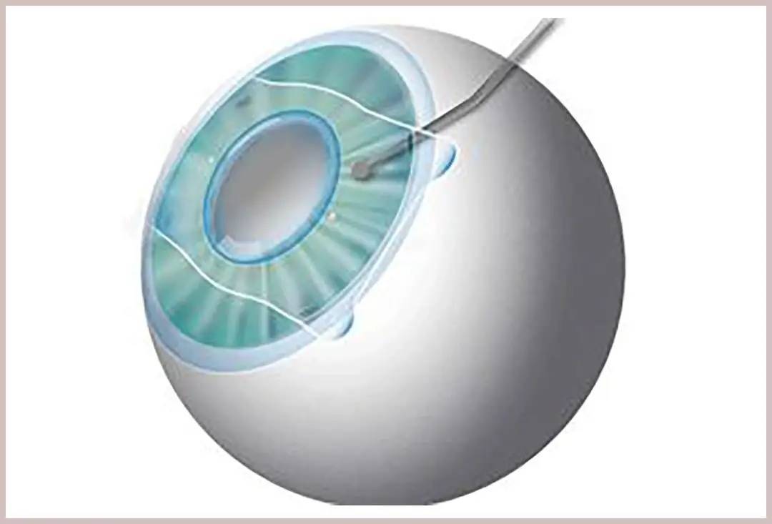 icl晶体植入手术适合所有人吗,2022重庆近视手术医院专家实力前三甲