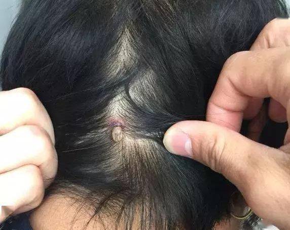赤峰有人被咬,这东西严重可致人死亡,要格外当心!_皮肤_患者_碘酒