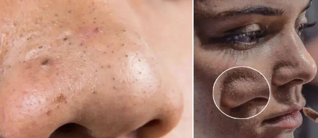 别再用手挤黑头,一贴一撕,陈年黑头连根拔起,素颜怼脸拍都没在怕!