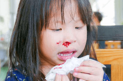 秋季小孩子流鼻血怎么处理(如何预防孩子流鼻血)