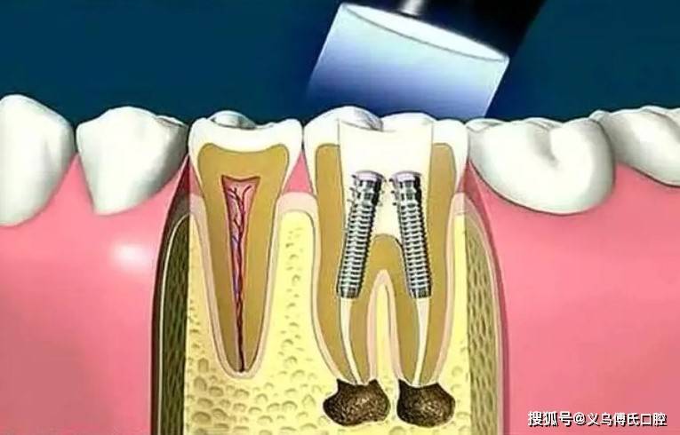 根管封药多次还疼的处理办法!_管内_氢氧化钙_治疗