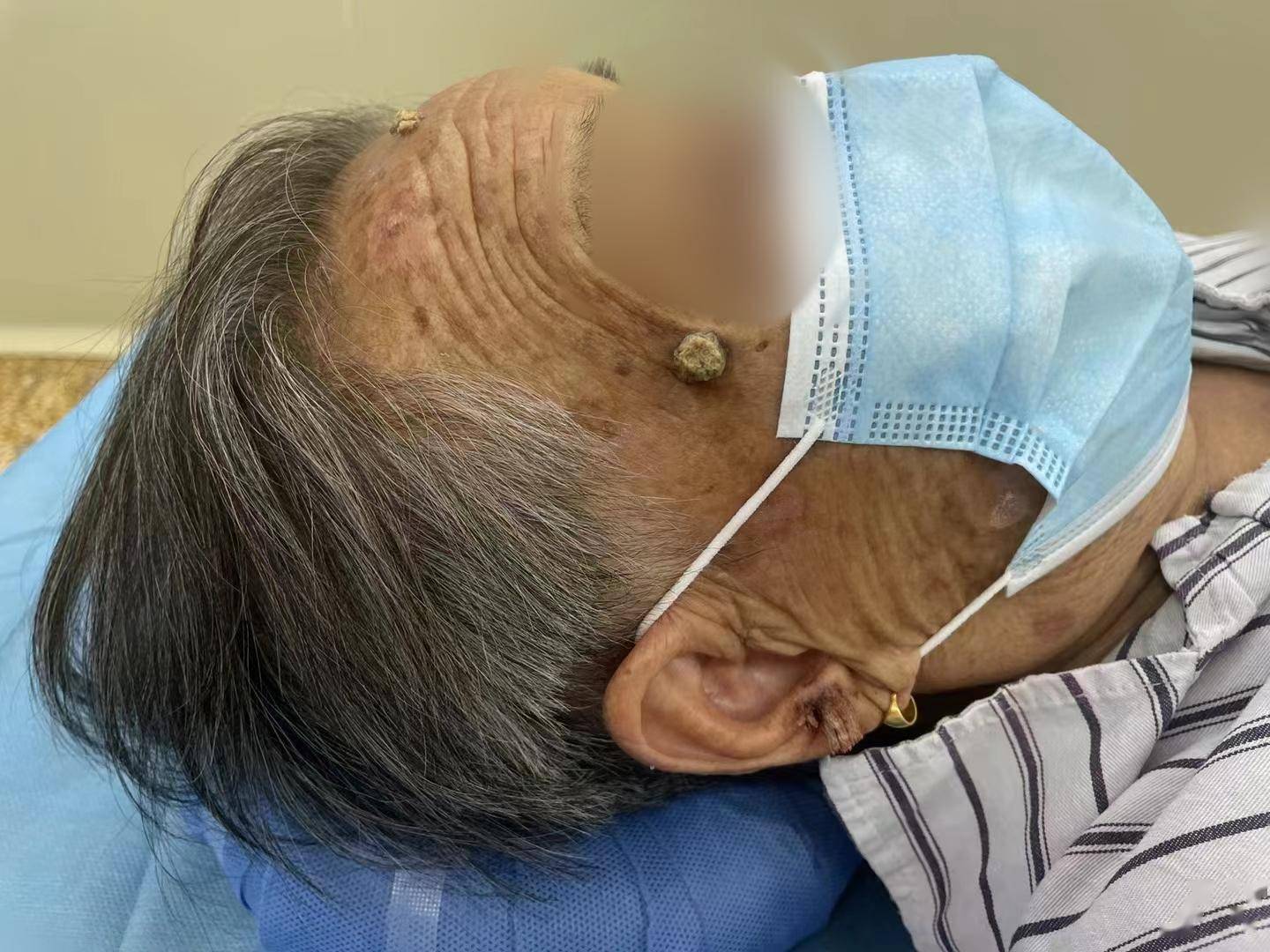 94岁老奶奶手上"开花",头上"长角",这是啥情况?