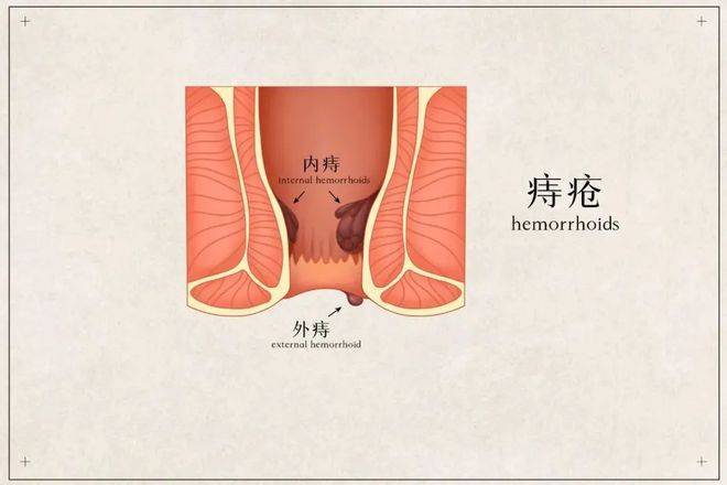 黑血便和黏液便;有慢性阑尾炎,大肠息肉,炎症性肠病,胆囊炎或已切除