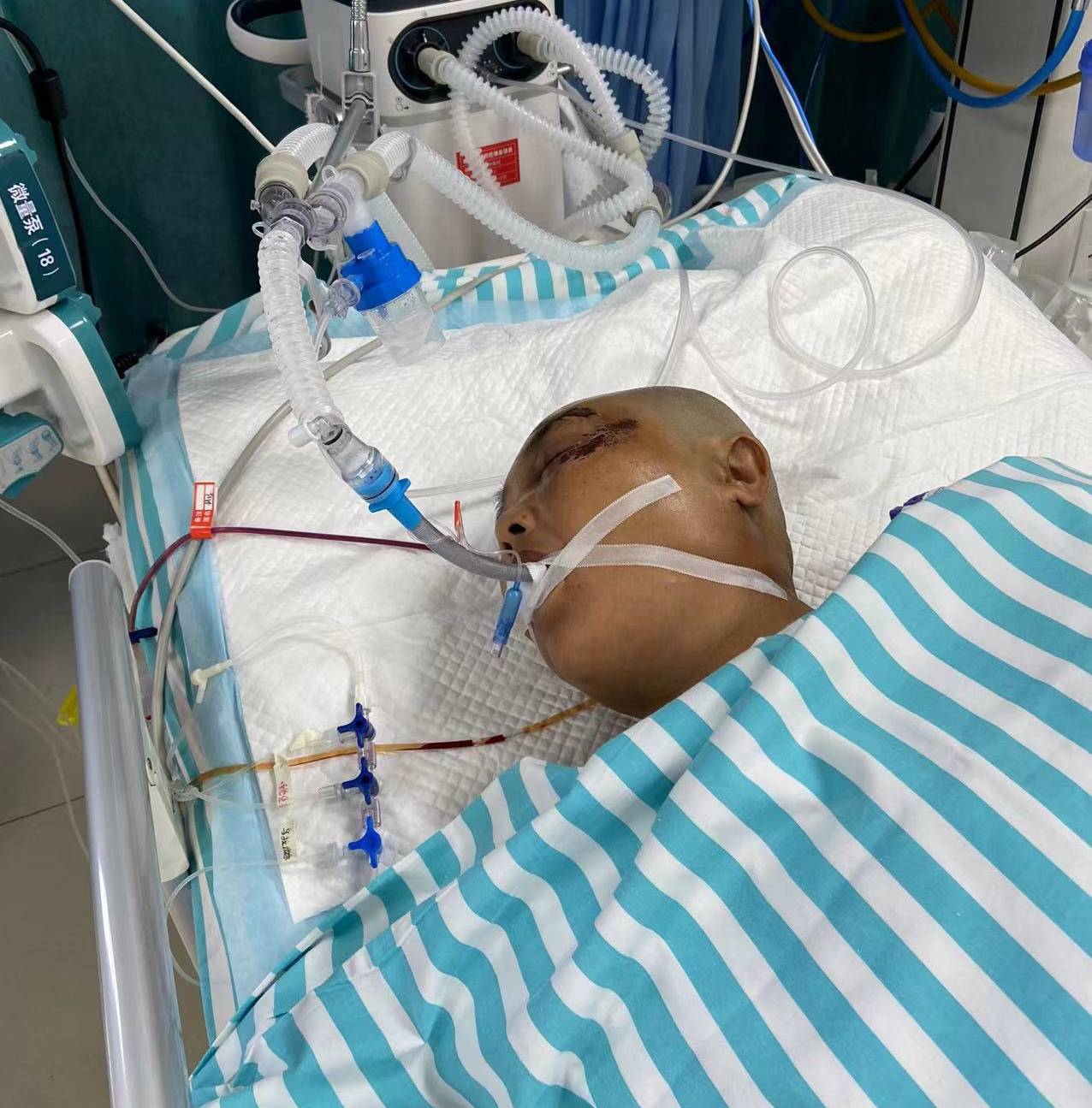 母亲严重摔伤昏迷不醒,两天花费6万多,恳请大家救救我的母亲!