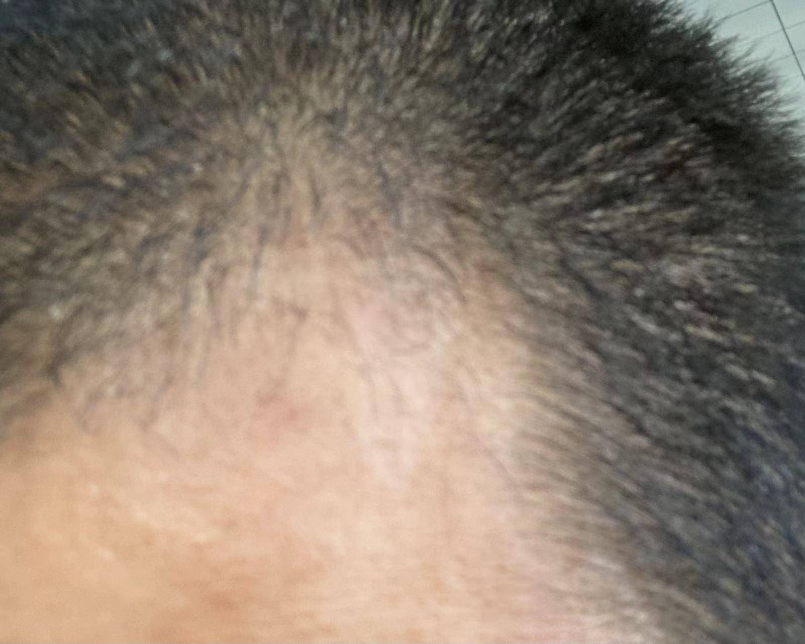 米諾地爾1個月打卡，左右兩邊髮量不一樣，是我用的不平均嗎？