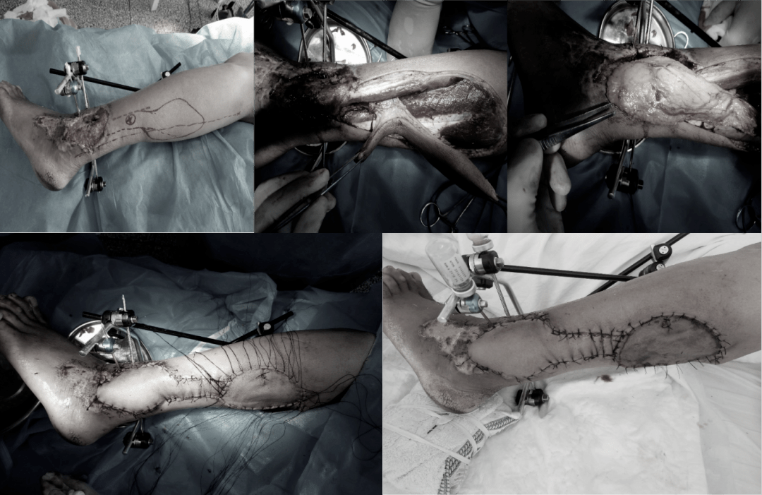 州医院凤仪分院手足显微外科:毫厘之间 尽显匠心_治疗_手术_移植