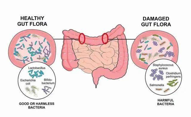 “坏”肠道菌群过多，导致肠道健康状况不佳