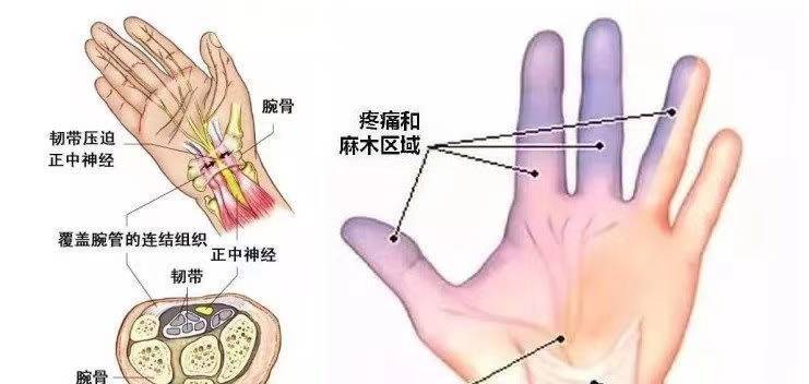 在手和手腕的這些肌腱周圍,一般都有腱鞘的包裹.