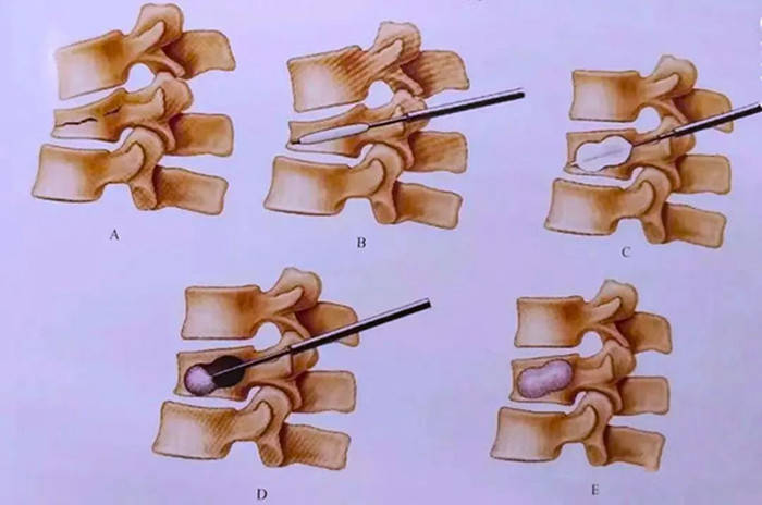 动态平板c臂在经皮椎体球囊扩张成形术的应用-案例分享_成像_手术