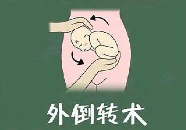 产科刘畅医生就来给您介绍一下何为外倒转术：外倒转术（external cephalic versio