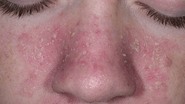 鼻子两边脂溢性皮炎图图片