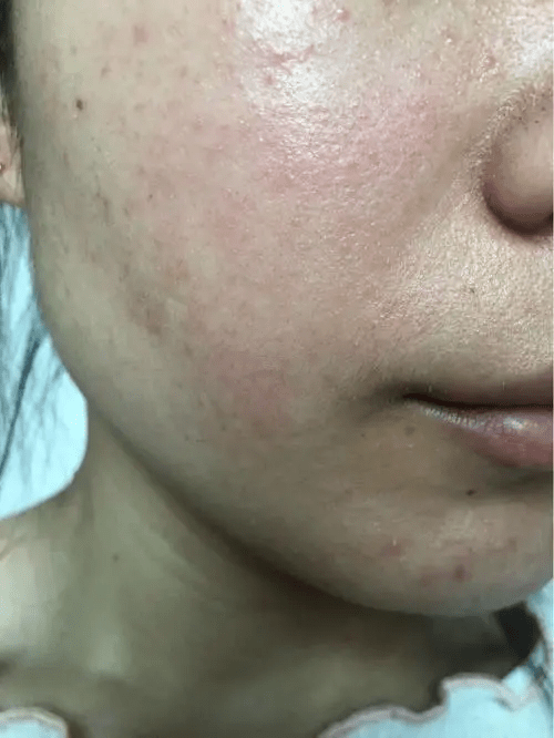 激素脸排毒红肿多久能退红?_药膏_护肤品_肌肤