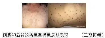 【"三病"防治知识科普】话说性病之梅毒的早期皮肤表现_治疗_药物
