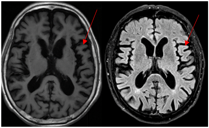 磁共振显示脑萎缩痴呆往往是缓慢发展的