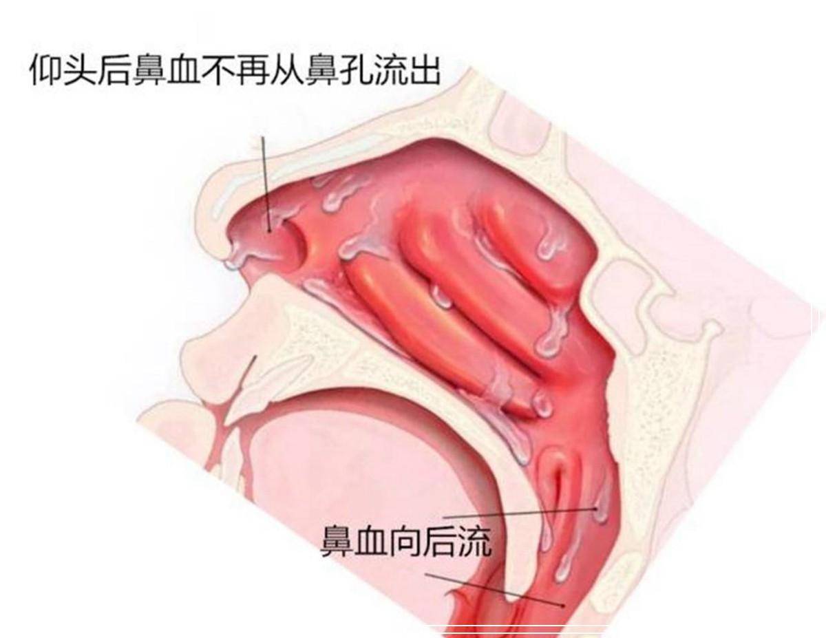 孩子流鼻血,妈妈用错误的方法处理,3岁孩子被送进抢救室