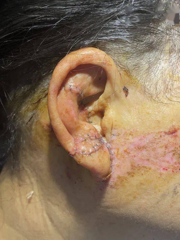 兰人医耳鼻喉科团队成功让它"长"了回去_手术_医生_耳廓