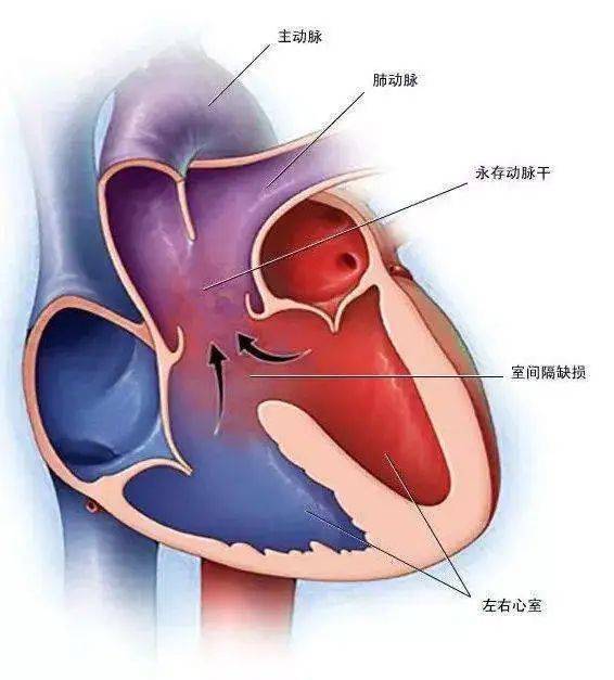 一文读懂室间隔缺损_孩子_宝宝_医生
