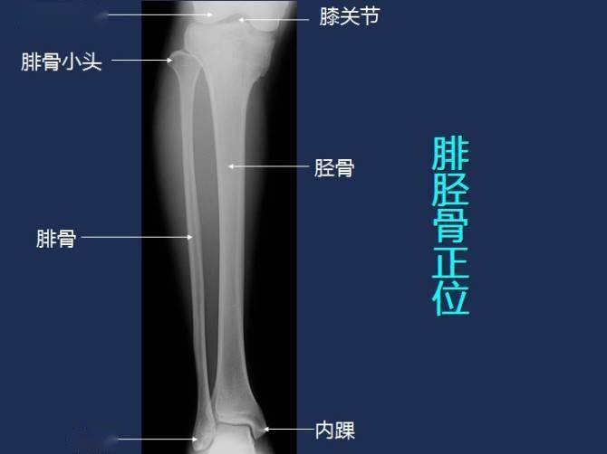 胫骨X线侧位片解剖图图片