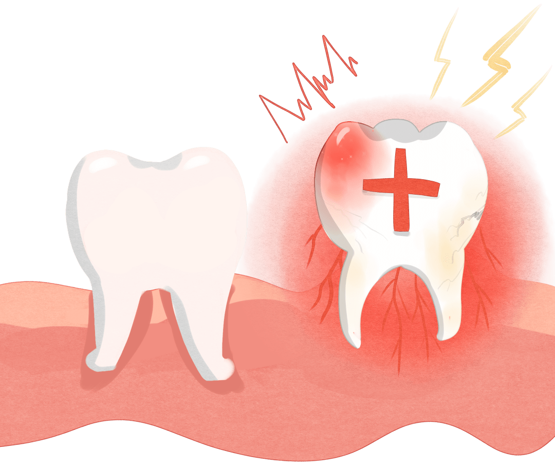 口腔内围绕牙齿的牙周袋内存在着近似于手掌面积大小的发炎溃疡面