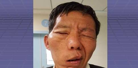 运动功能障碍为主要特征的一种常见病,导致这样的情况,很可能是脑中风