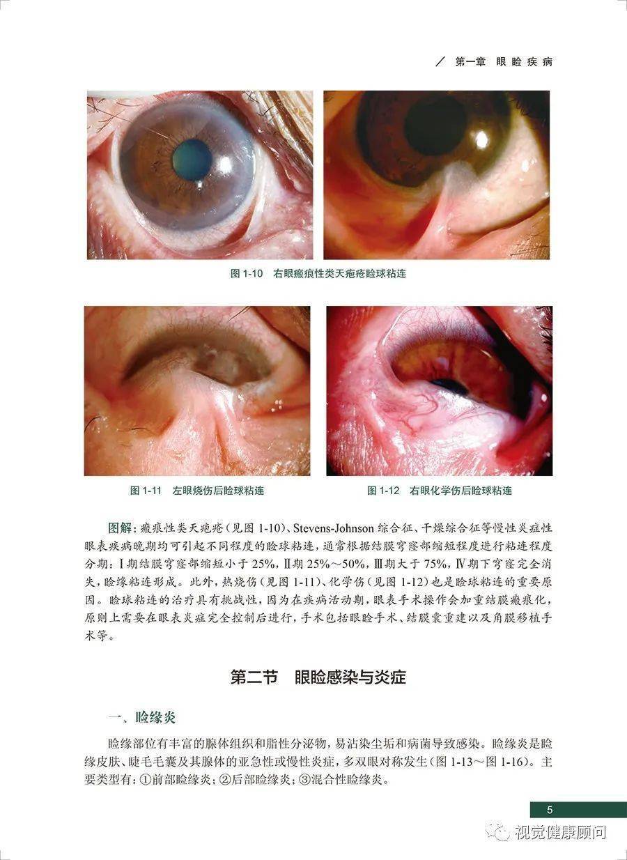 眼前節疾病裂隙燈圖像解讀_眼瞼_結膜_第四節