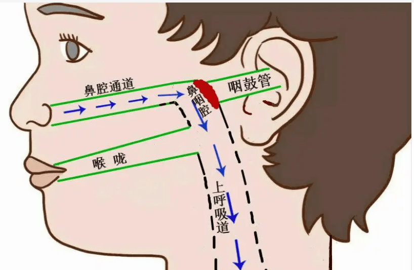 其实这可能是由于咽鼓管异常开放,导致中耳腔和鼻咽部相通,共振腔增大