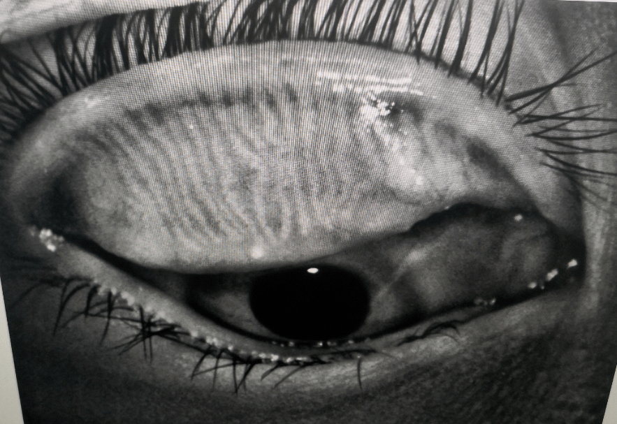 睑板腺呈平行竖线状分布在眼睑内,睑板腺长期堵塞就会逐渐出现弯曲
