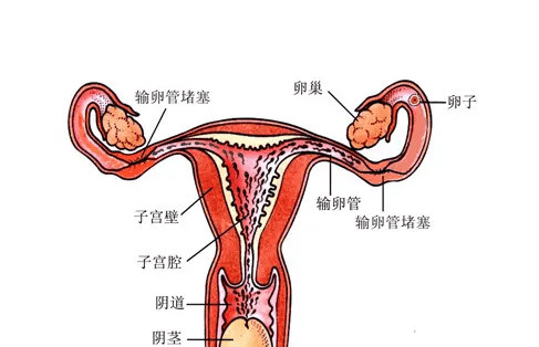 女性输卵管堵塞有哪些预防方法