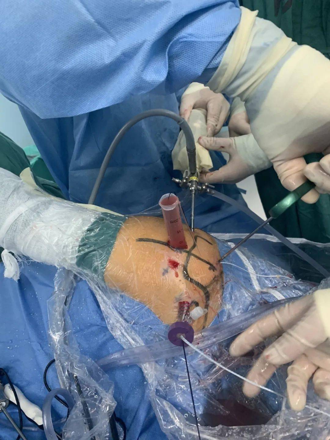9月底,在手术室医护团队的配合下,李欢团队站上手术台,通过肩关节镜