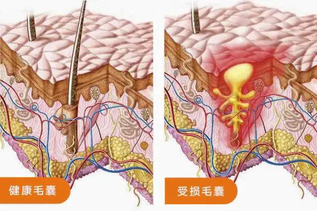 头发毛囊堵塞怎么办图片