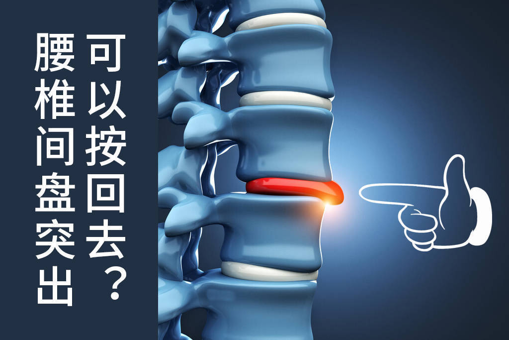 腰椎间盘突出可以按回去吗?_按摩_治疗_姿势