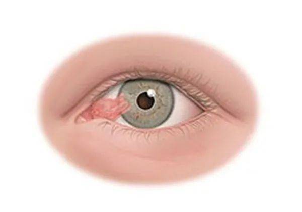 眼睛长了块肉,这病严重吗?_手术_眼球_移植