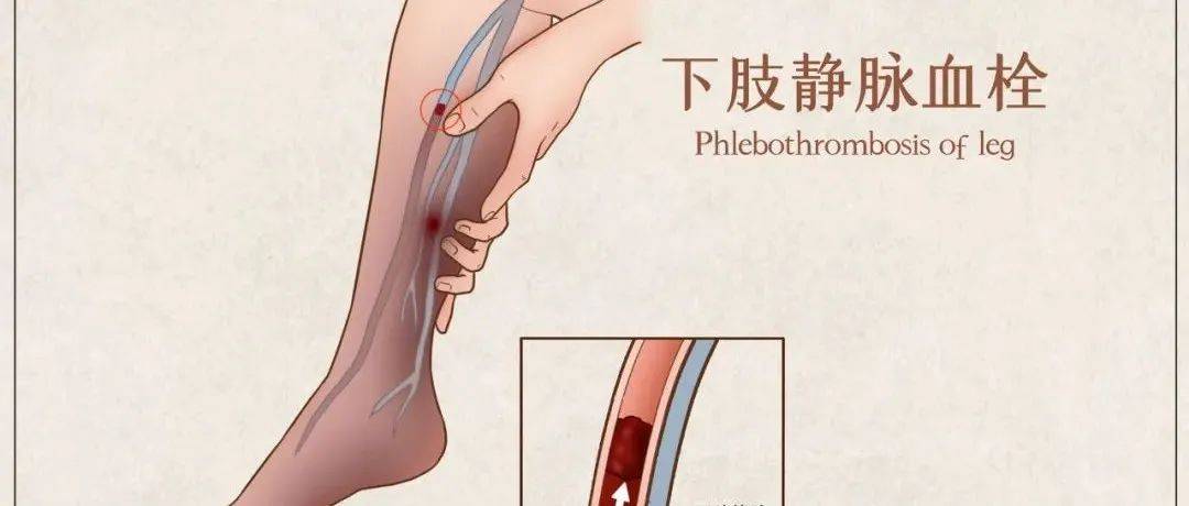 世界血栓日|如何保护血管 别被疾病“拴”住_血液_栓塞_动脉