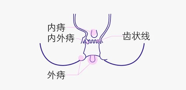 女生长痔疮的位置图片图片