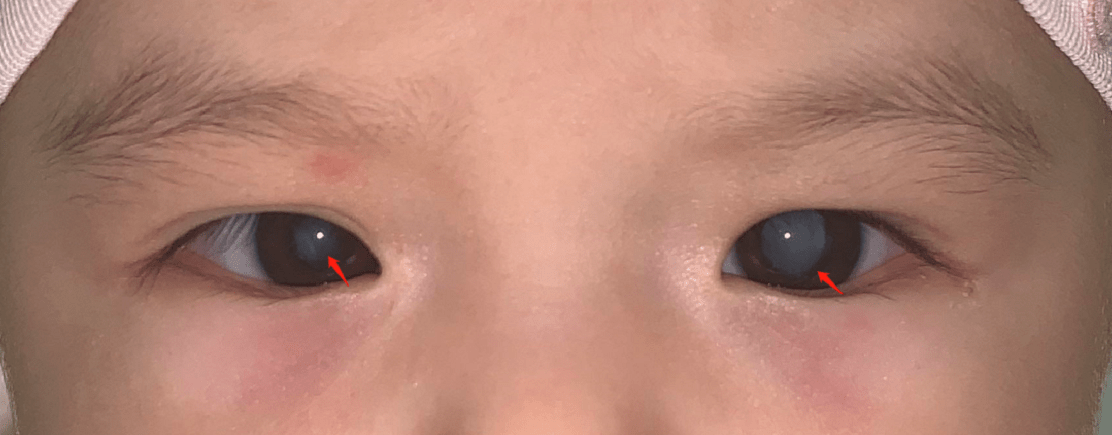 关注新生儿眼病,为孩子明亮眼眸把好第一关,开启"睛"彩新视界_白瞳