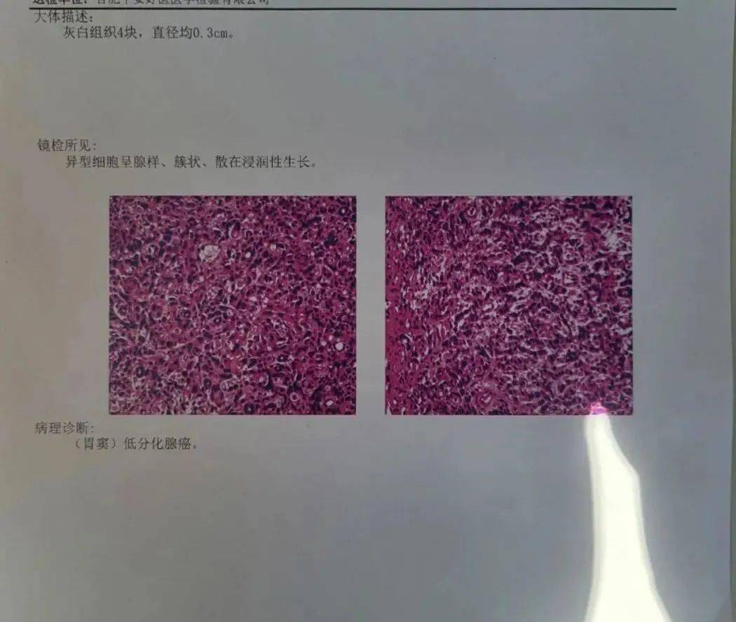 胃癌报告单图片样本图片