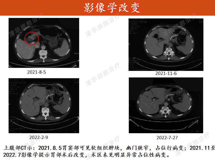 83岁高龄患印戒细胞癌,是细胞治疗让他多一个治疗手段_先生_肿瘤_患者