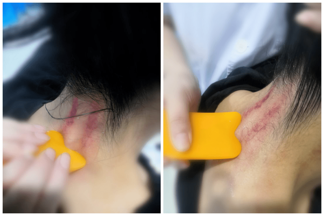 原来,刮个痧还有那么多讲究……_刮痧_部位_进行