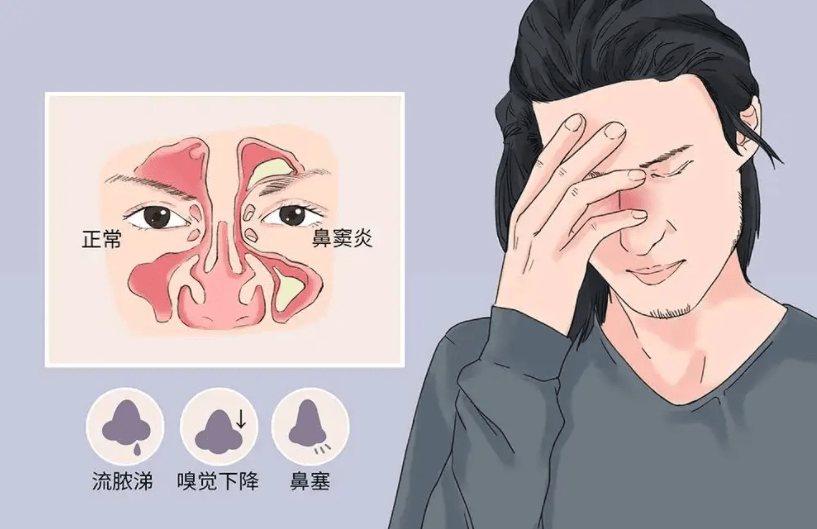 鼻塞鼻堵别大意,警惕鼻窦炎!_影响_危害_患者