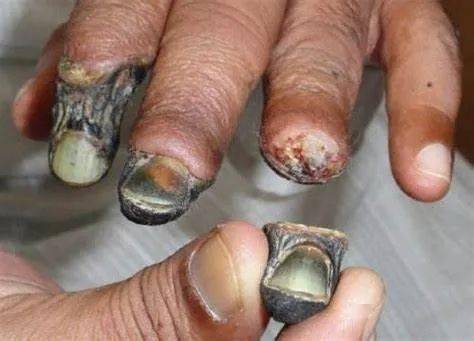 最后仅仅剩下一具白骨而死去让吸食"鳄鱼"的人变成腐烂人直到只剩下白