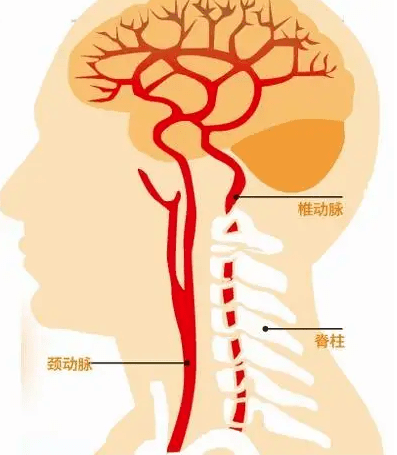 远离椎动脉和颈动脉夹层人的血管就像毛竹一样,有一层内膜,尤其是椎