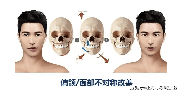 上海九院韦敏 | 什么是偏颌,下巴会歪?_畸形_患者_下颌