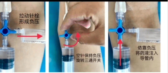 这样做,搞定鼻肠管堵管难题!_管道_营养液_患者