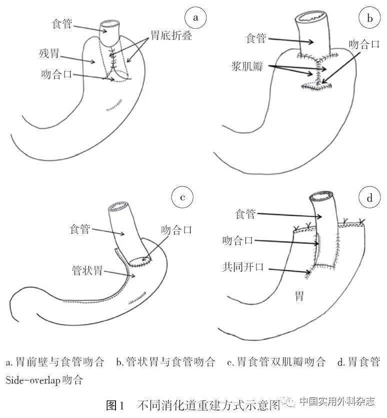 近端胃双通道示意图图片