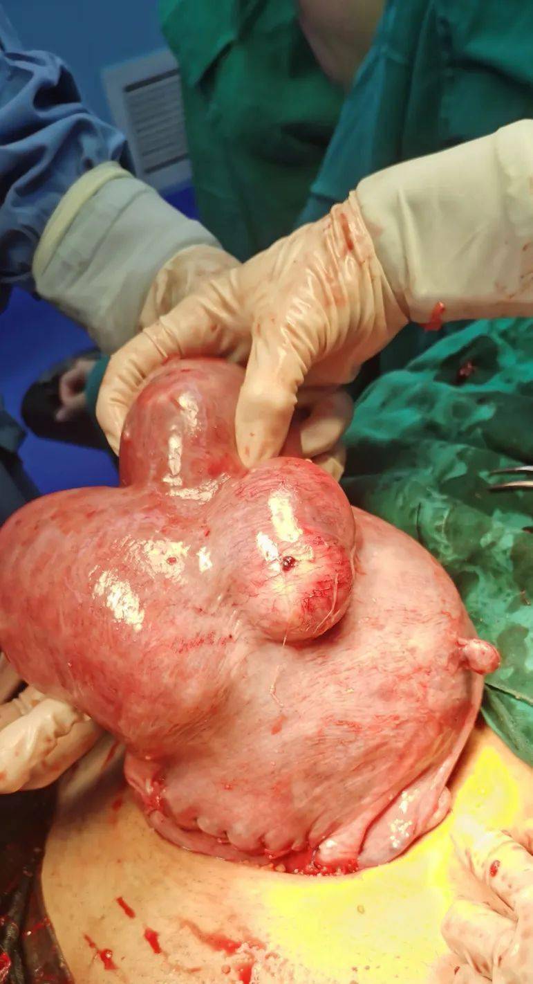 子宫肌瘤手术全过程图图片