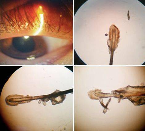 怎么判断眼睫毛有螨虫图片
