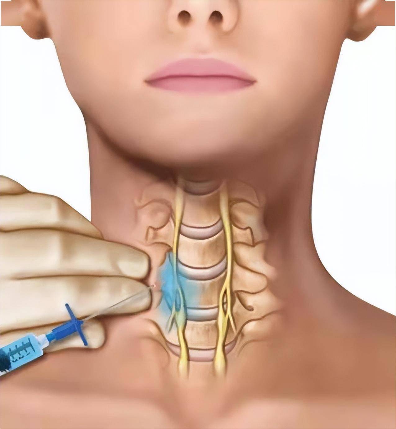 焦虑,失眠,头痛……您知道什么是"星状神经节阻滞疗法"吗?