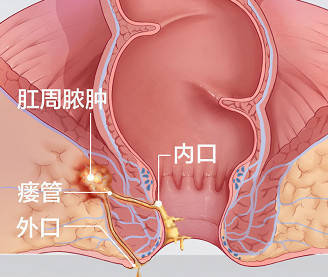 女性直肠阴瘘图片